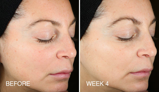 Universal C Skin Refiner Before After 100% Result – Beautystat – Harvey Prince Organics-2