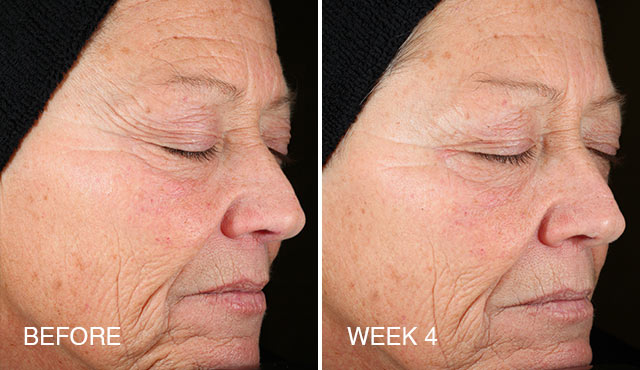 Universal C Skin Refiner Before After 100% Result – Beautystat – Harvey Prince Organics-3