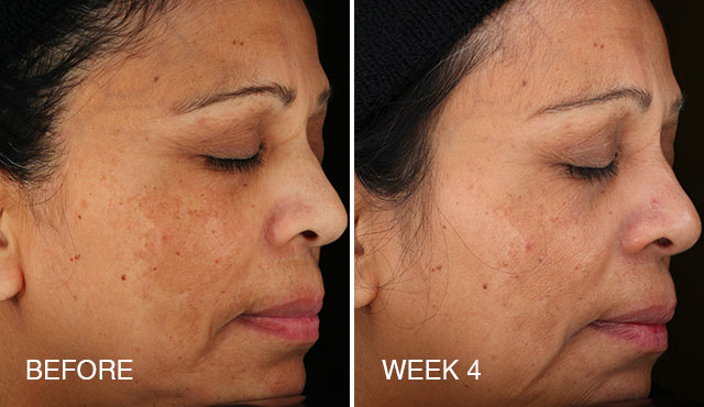 Universal C Skin Refiner Before After 100% Result – Beautystat – Harvey Prince Organics-4